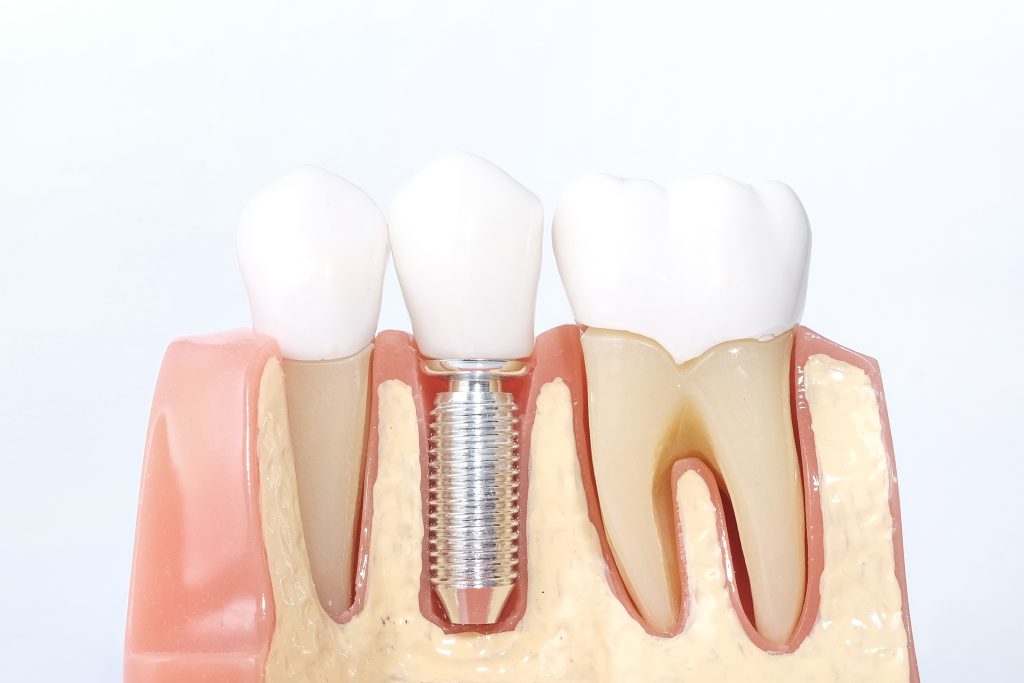 3-D image of a tooth implant screwed into a jaw